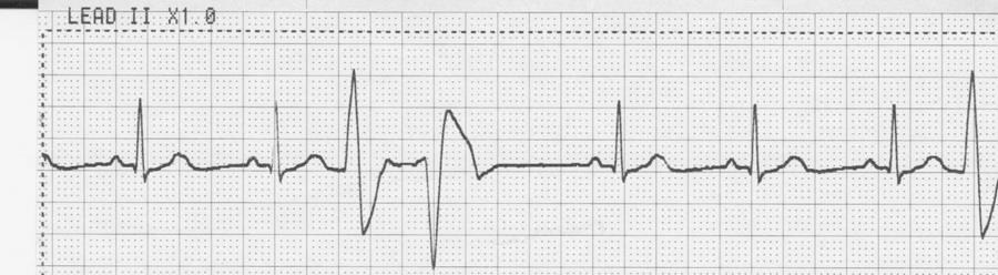 8. Identify the cardiac rhythm / dysrhythmia seen on the following ECG strip. a. Sinus rhythm with bigeminy multifocal PVC b. Sinus rhythm with monogeminy couplet PVC c.