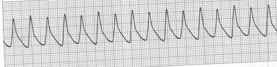 Identify the cardiac rhythm / dysrhythmia seen on the following ECG strip. a.