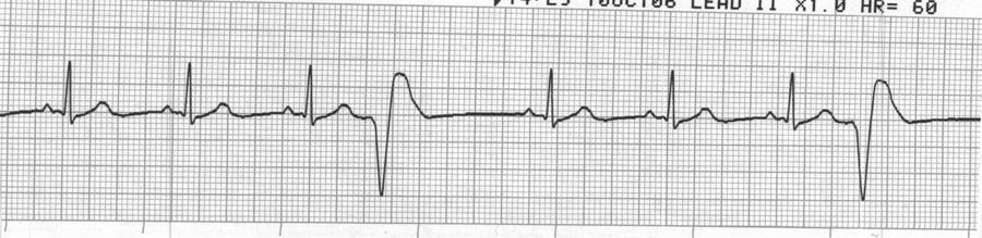 Ventricular tachycardia 13.