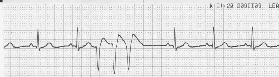 14. Identify the pattern and morphology seen on the ECG strip below. a. Artifact from loose electrodes b.