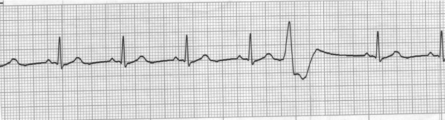 Identify the pattern and morphology seen on the ECG strip below. a. Sinus rhythm with PAC b.