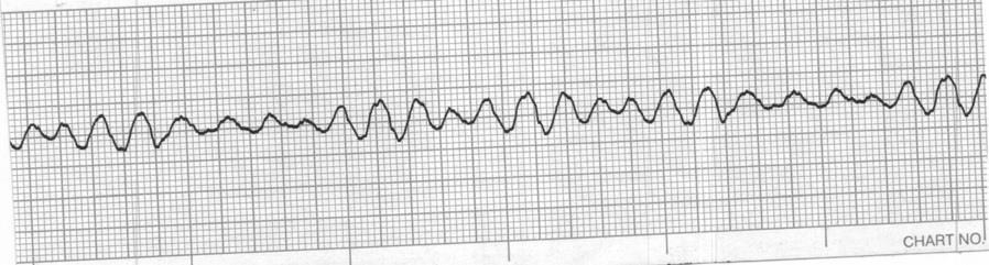 Identify the cardiac rhythm / dysrhythmia seen on the following ECG strip. a. Accelerated idioventricular b. Idioventricular c. Ventricular fibrillation d.