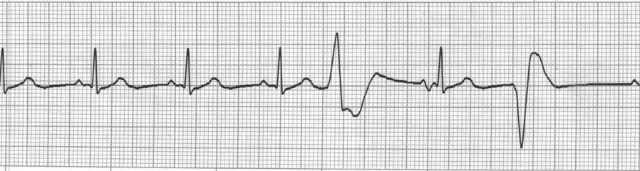 20. Identify the abnormal complexes seen on the following ECG strip. a. Bigeminy PVCs b.