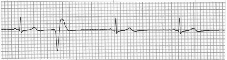 Identify the cardiac rhythm / dysrhythmia seen on the following ECG strip. a.