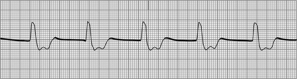 23. How are patients with the dysrhythmia seen in question 22 initially treated? a. Check the patient, call Code Blue, perform CPR and ALS measures, and give cardiac medications b.