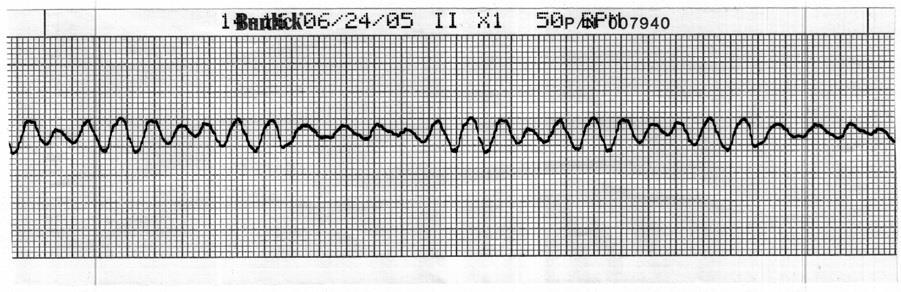 Check the patient, call a Code Blue, terminate resuscitative efforts 24. Identify the cardiac rhythm / dysrhythmia seen in the following ECG strip. a. Accelerated idioventricular b.