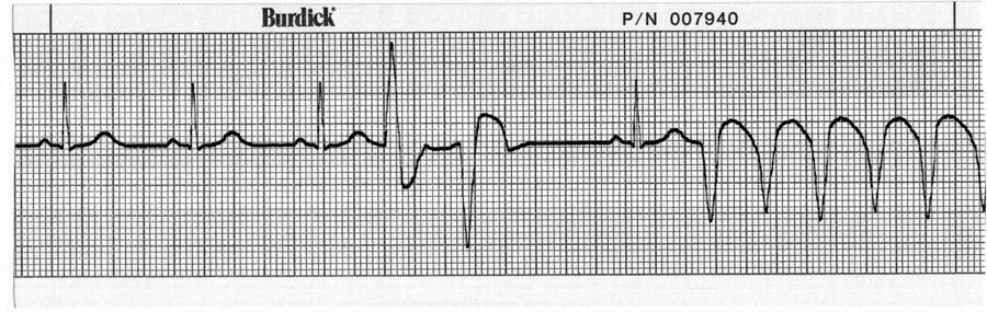 40. What is the first thing you should do when you recognize a dysrhythmia on the patient s heart monitor? a. Call a Code Blue b. Charge the defibrillator c. Check the patient d.