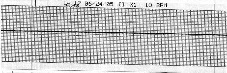43. Identify the cardiac rhythm / dysrhythmia seen in the following ECG strip. a.