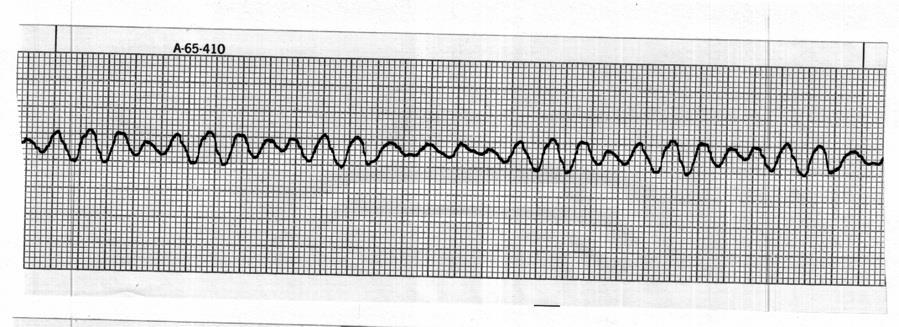 Identify the cardiac rhythm / dysrhythmia seen in the following ECG strip. a.