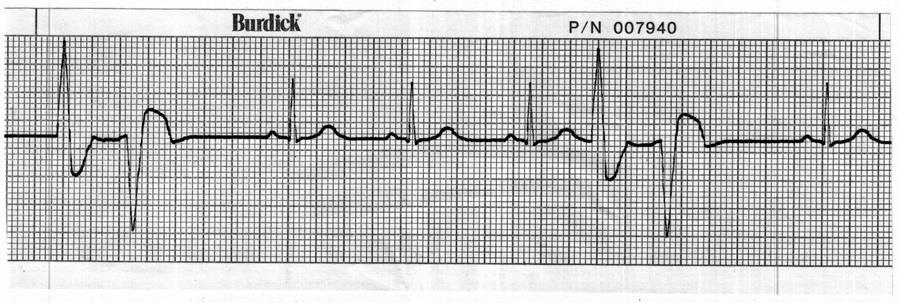 45. Identify the cardiac rhythm / dysrhythmia seen in the following ECG strip. a.
