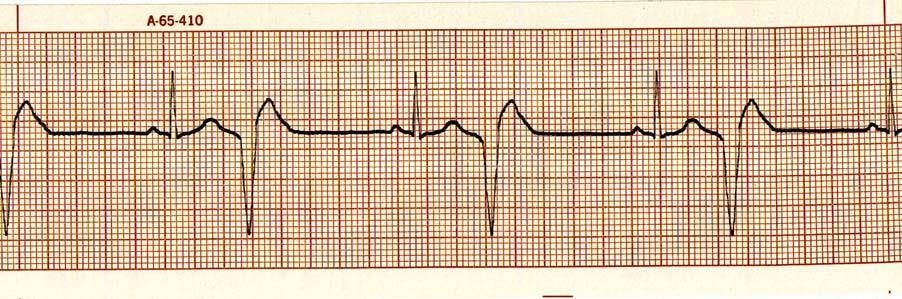 47. Identify the cardiac rhythm / dysrhythmia seen in the following ECG strip. a.