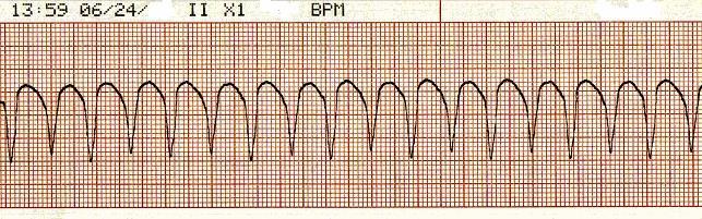 What is the most accurate heart rate in following ECG
