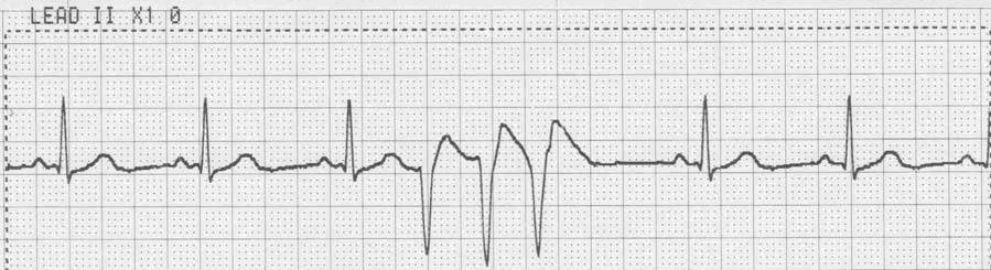 ECG Tracings of Sinus Rhythm with PVCs Following are four examples of ECG tracings of