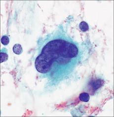 Cytologic Atypia: WARD Cells Atypical cells in benign pleomorphic adenomas