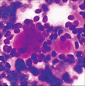 tumor Oncocytoma Acinic cell carcinoma Epithelial-myoepithelial CA