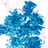 vacuolated cytoplasm; Histiocyte-like No