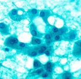 DDx: Acinic cell CA (zymogen granules) Bishop