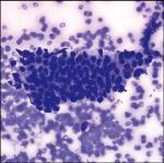 ± Patchy paradoxically normal FNA *vs