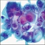 Stromal Fibrosis WARD Cells