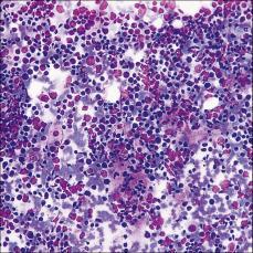 cells + lymphs Parenchymal atrophy, debris, protein ppt Metachromatic hyaline