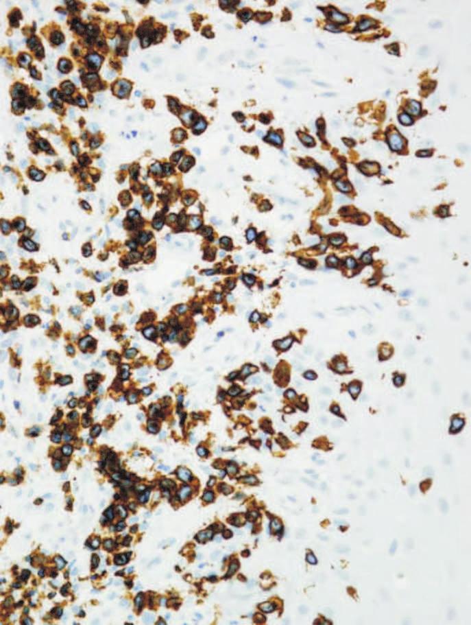 Fig. 1. IHC: the Tcell infiltrate CD3+ and with prominent epidermotropism; ob.