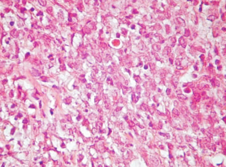 Immunohistochemistry was positive for CD20 (90%), ki- 67 (80%) and negative for Bcl-2. No evidence of metastatic lesion had been demonstrated.