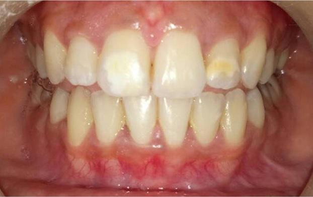 Research & Reviews: Journal of Dental Sciences generalized mild enamel hypoplasia and was severe in maxillary right central incisor and maxillary left lateral incisor (Figure 1).