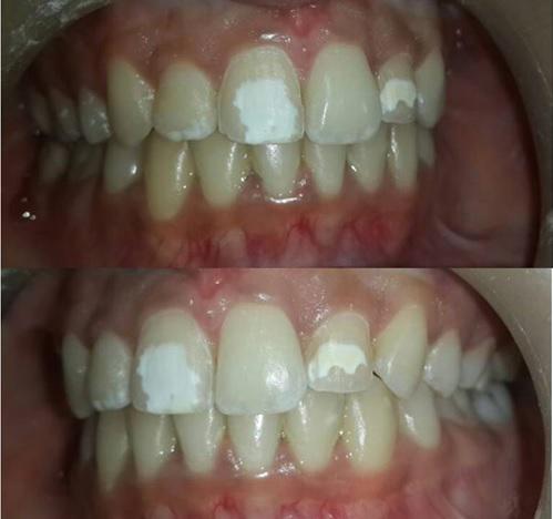 Later various conservative treatment options such as composite and porcelain laminate veneers were discussed with the patient.