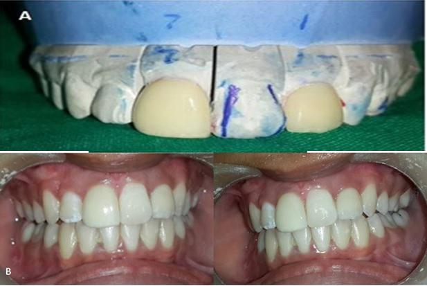 A putty wash impression was made using vinyl polysiloxane after gingival retraction. The shade was selected with VITA 3D master shade guide under direct sunlight.