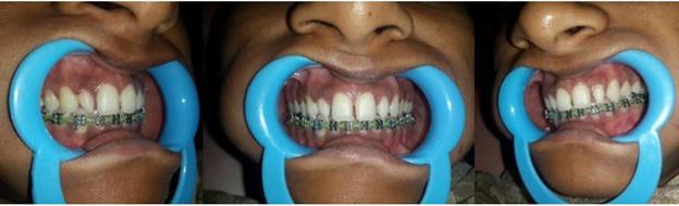 Research & Reviews: Journal of Dental Sciences Figure 4.