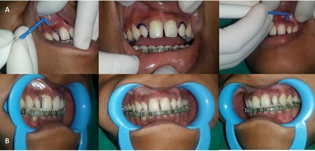 A: Laser gingivectomy photographs, B: Post gingivectomy photographs. Figure 6.