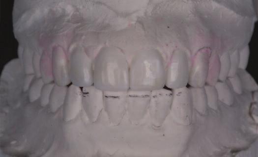 Outlines of various teeth shapes can be overlaid onto the existing dentition digitally whereby the aesthetics and positions of teeth and gums can be evaluated more thoroughly by the dentist,