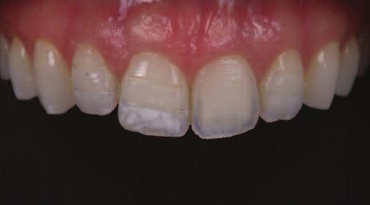 Furthermore no adhesive dentistry should be performed on teeth for two weeks after whitening as bond strengths may be compromised from the residual components.