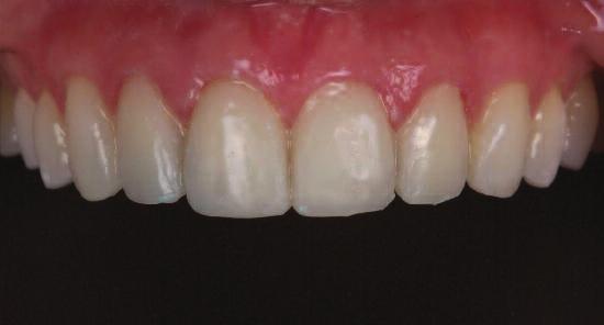 4 The final diagnostic wax-up was presented to the patient during the two week whitening followup.