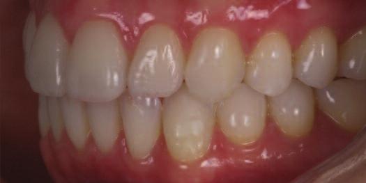 The majority of the excess resin cement was removed leaving only a small amount on the margins. The restorations were cured with a Valo LED curing light (Ultradent Corporation).