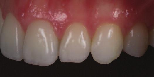 (fig 15-23) Occlusion and excursives were then verified with TrollFoil (Troll Dental) and shimstock (Almore).