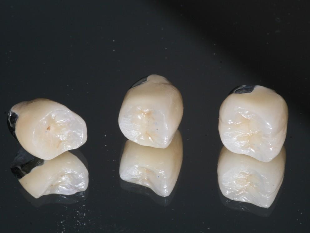 Porcelain Fused to Metal Crowns Porcelain fused to metal (PFM) crowns are tried and true, and compromise approximately 80% of the crowns