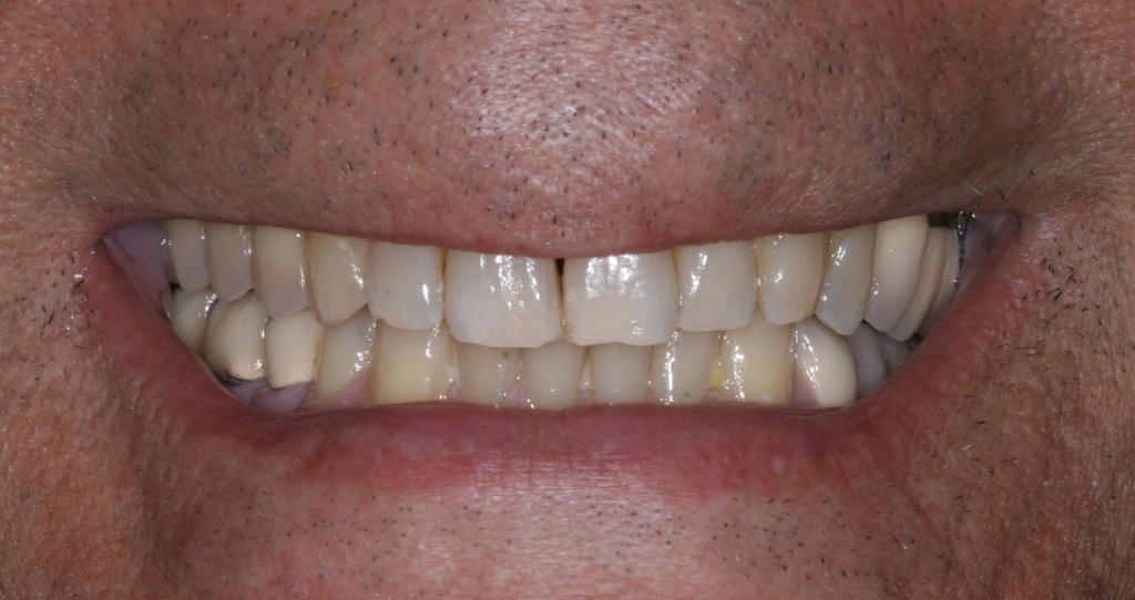 For example, the esthetic of PFM crowns is limited by the metal framework and the layer of opaque porcelain needed for masking the underlying