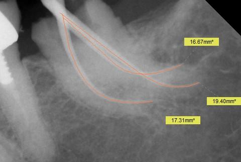 Root Canal Treatment Tooth #18 presented with a fracture in close proximity to the pulp chamber which