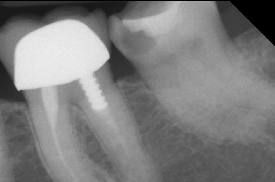 not treated accurately, these problems will render the tooth hopeless and necessitate extraction.
