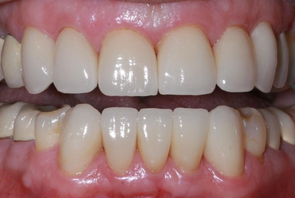 Porcelain Crowns The upper and lower incisors exhibited a classic case of dental attrition.