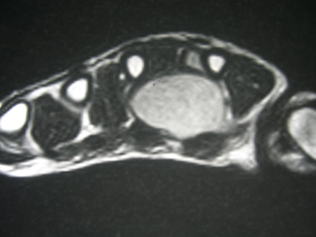 Fig. 10: Same patient as in Figure 8 and 9. Coronal T1-weighted postcontrast showing a diffuse uptake of the mass. Fig. 11: Synovial sarcoma of the hand.