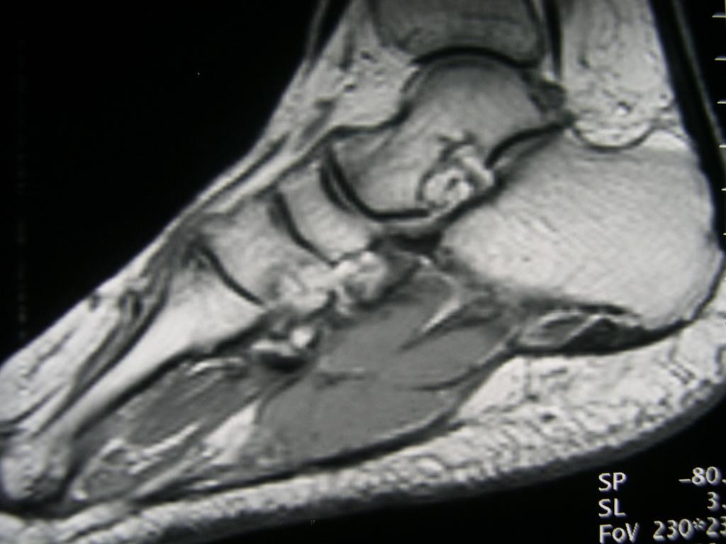 Fig. 14: Synovial sarcoma of foot.