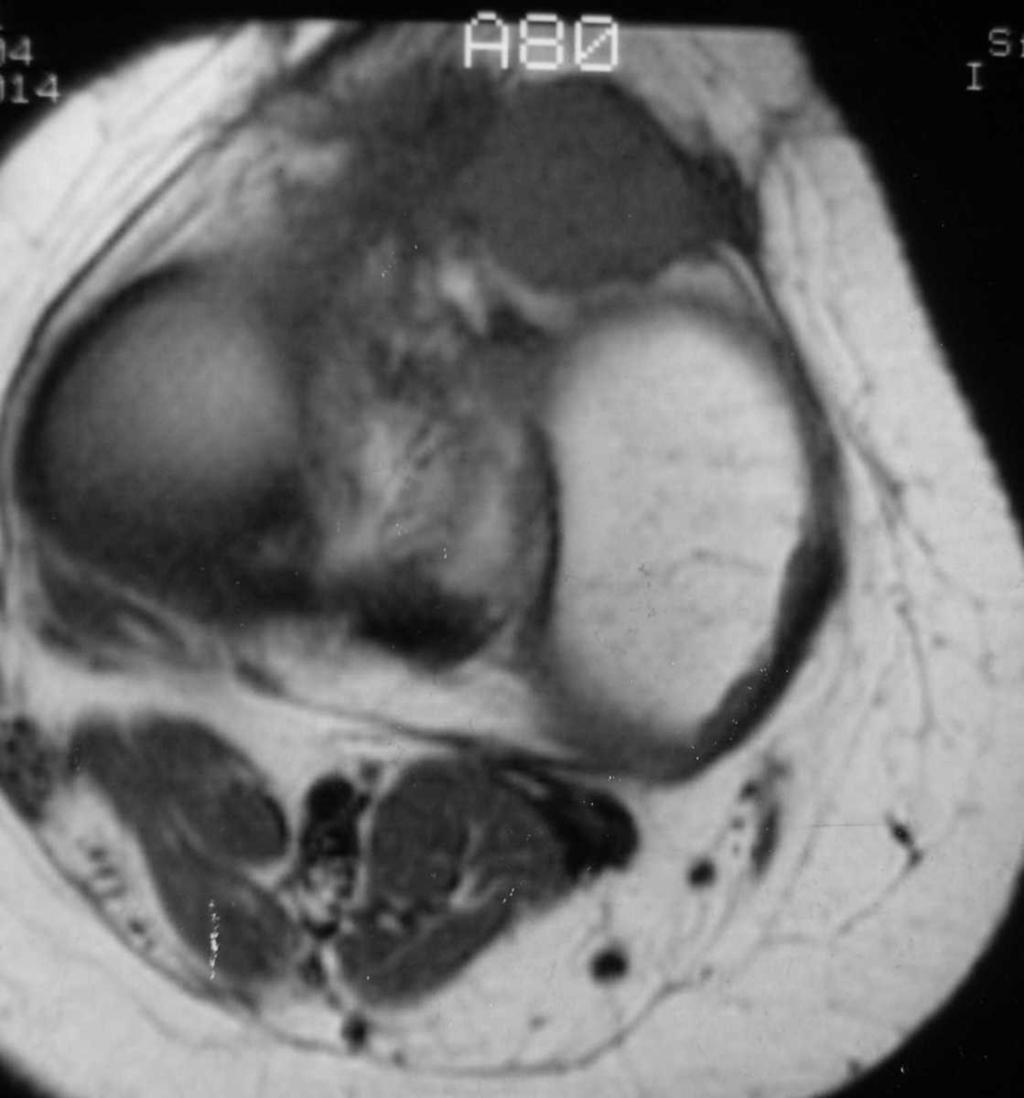 Fig. 18: Axial T1-weighted shows a well defined soft tissue tumor in