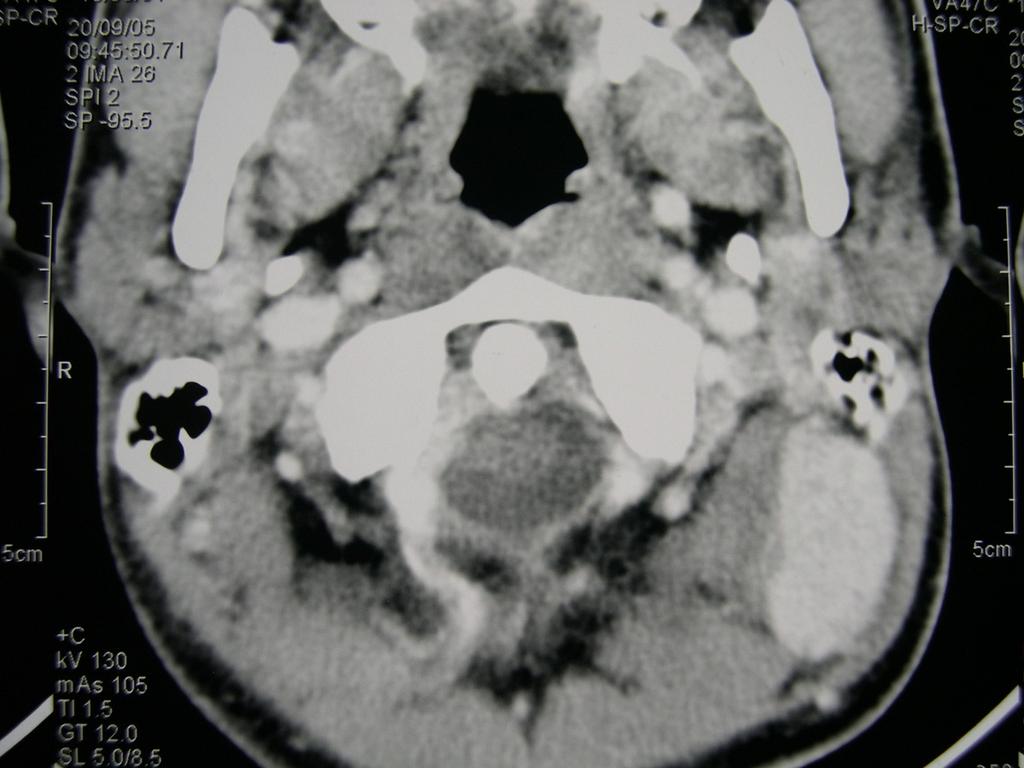 Fig. 29: Synovial sarcoma neck.