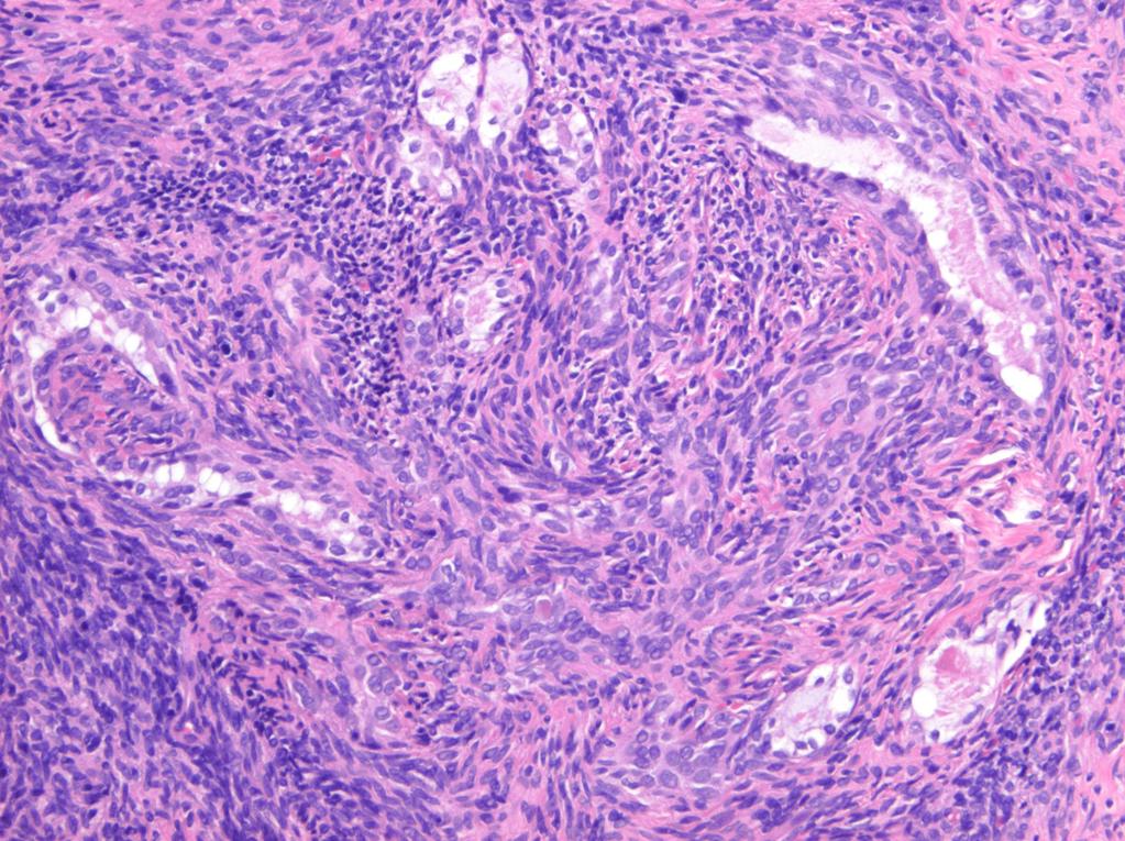 Fig. 3: Photograph of biphasic synovial sarcoma (H-E x 100).