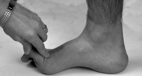 A common reason that the arch does not elevate is muscle weakness, particularly the tibialis muscles.