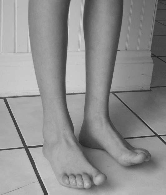 Treatment Retraining Dorsal and Plantar Flexor Muscles The child can be taught to do repetitive toe raises and heel walking to stimulate recruitment of the muscles supporting the arches (Figs 7.