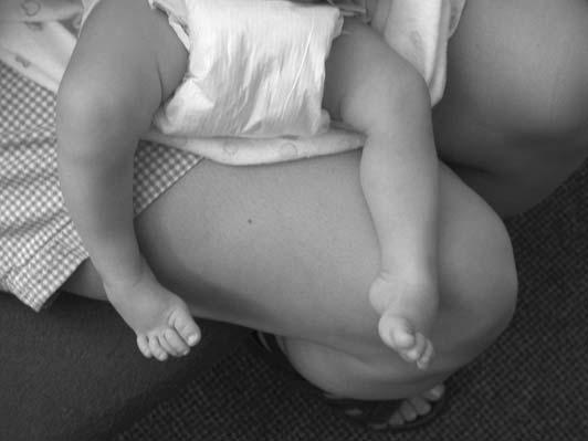 Severe metatarsus adductus can be confused with clubfoot in infants and newborns. However, unlike clubfoot, the adduction deformity only involves the forefoot whereas the hindfoot is quite flexible.