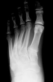 Stress Fracture Repetitive Injury